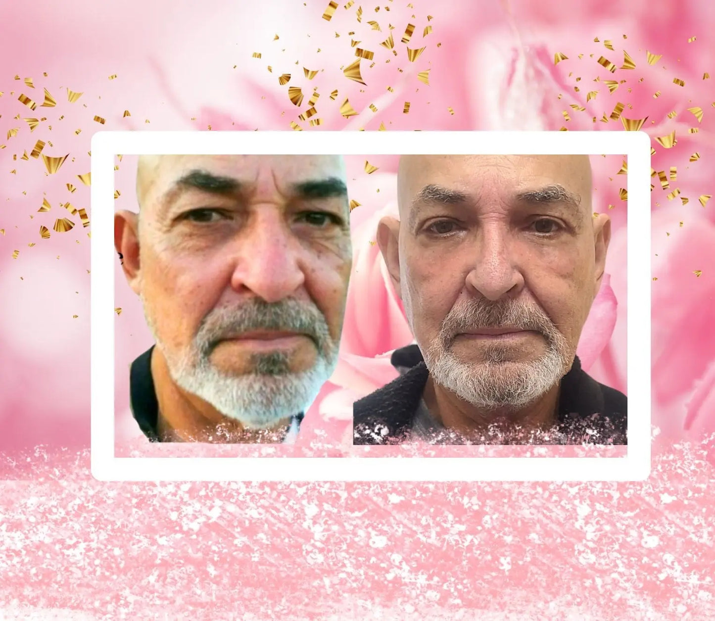 Anti-Aging Face Lift Facial Non-Surgical Sacramento