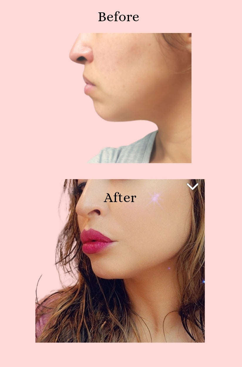 Lip Filler Hyaluronic Pen plump lips non-injection treatment