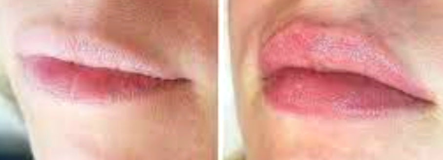 Lip Filler Hyaluronic Pen plump lips non-injection treatment
