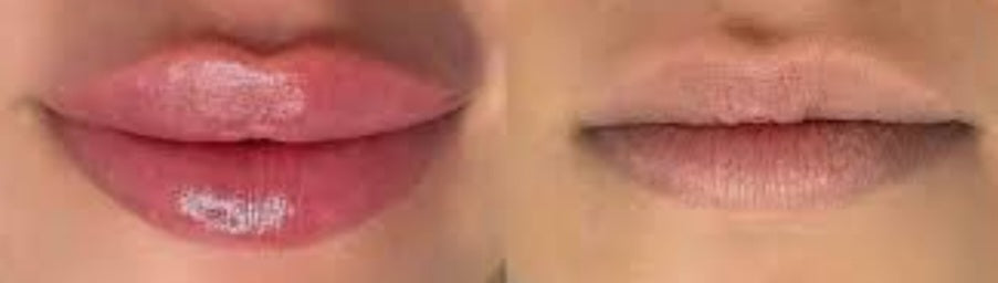 Lip Filler Hyaluronic Pen plump lips non-injection treatment
