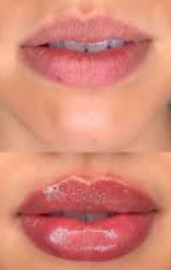 Lip Filler Hyaluronic Pen plump lips non-injection treatment