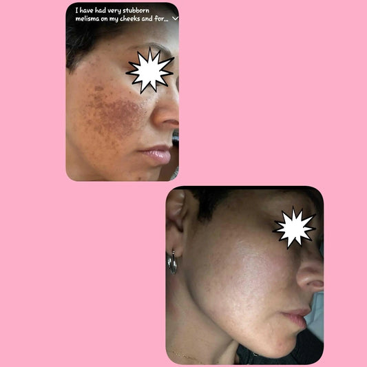 Hyperpigmentation Facial Treatment | Even Skin Tone Facial