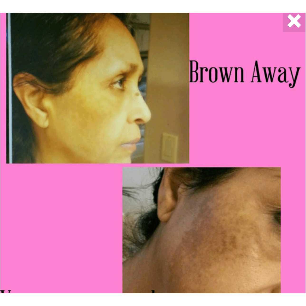 Hyperpigmentation Facial Treatment | Even Skin Tone Facial