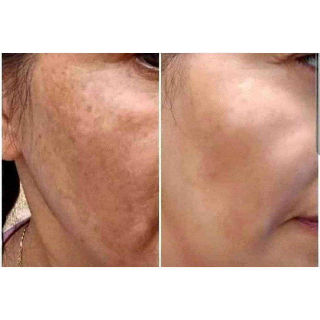 Hyperpigmentation Facial Treatment | Even Skin Tone Facial