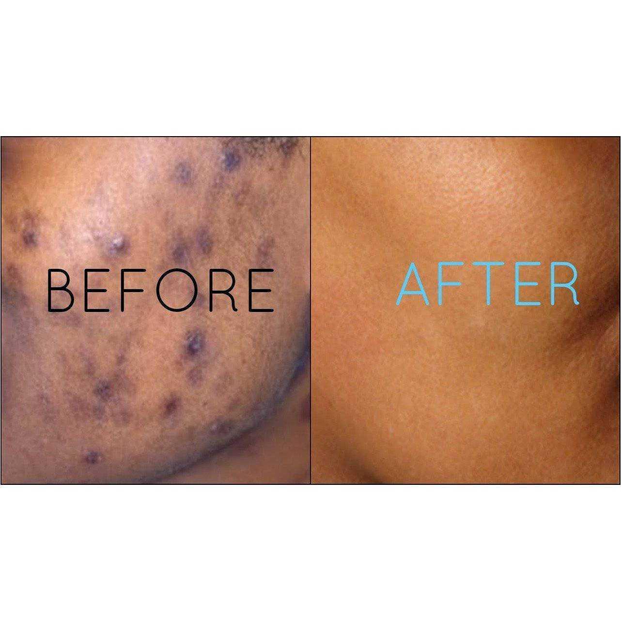 Hyperpigmentation Facial Treatment | Even Skin Tone Facial