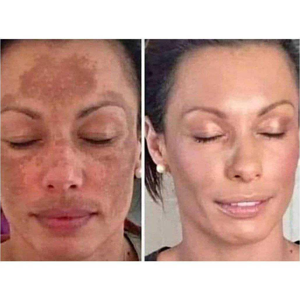 Hyperpigmentation Facial Treatment | Even Skin Tone Facial