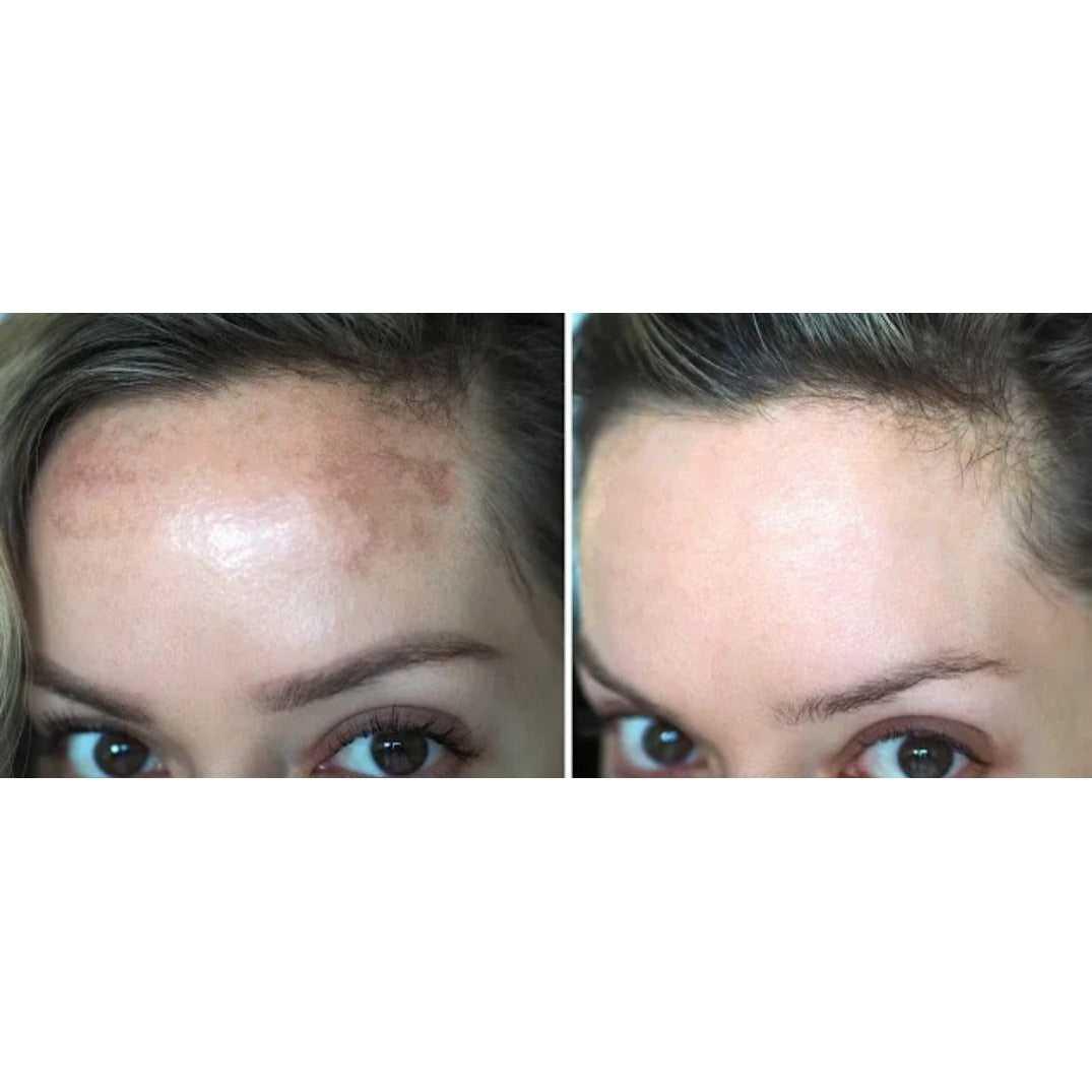 Hyperpigmentation Facial Treatment | Even Skin Tone Facial