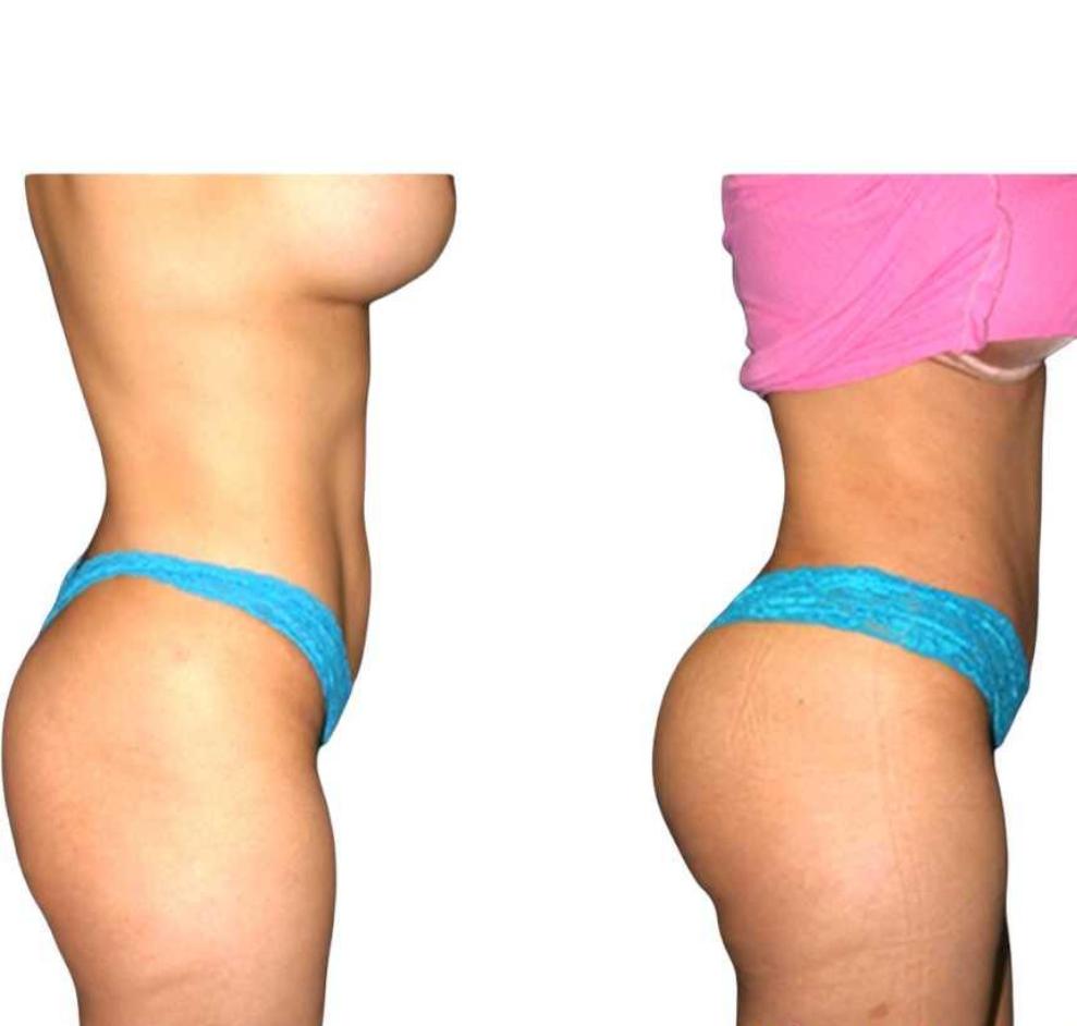 Body Sculpting Sacramento Non-Surgical Contouring Massage Spa