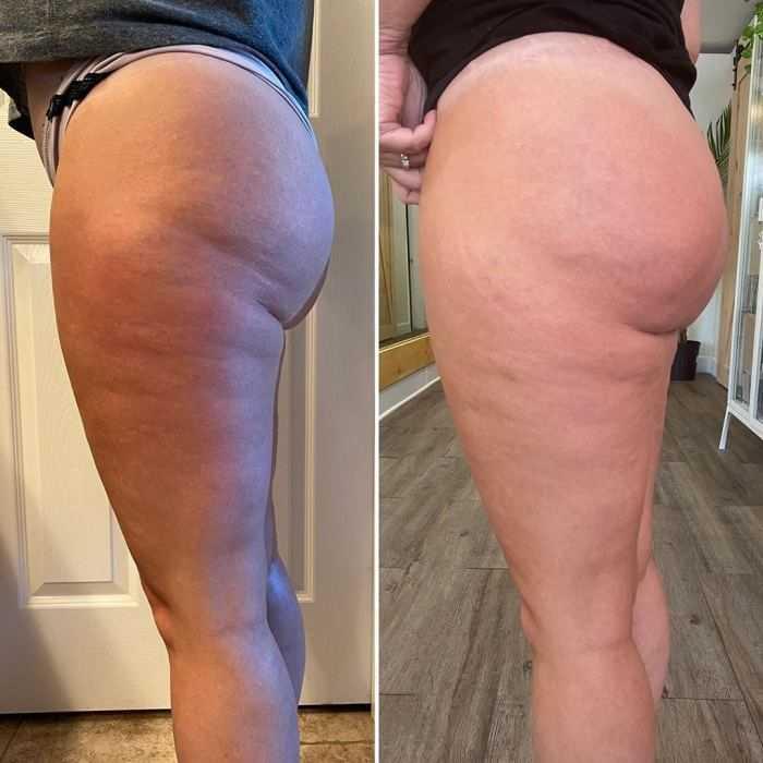 Body Sculpting Sacramento Non-Surgical Contouring Massage Spa