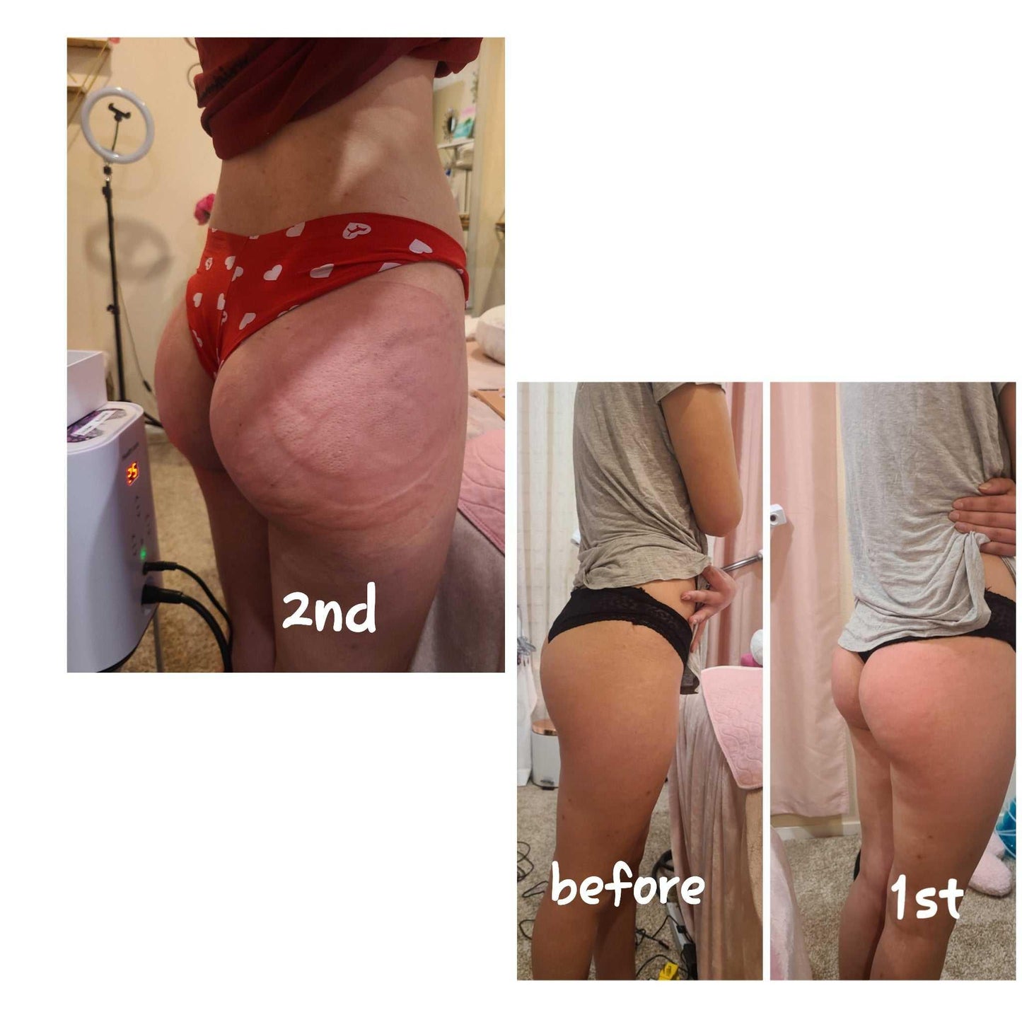 Body Sculpting Sacramento Non-Surgical Contouring Massage Spa