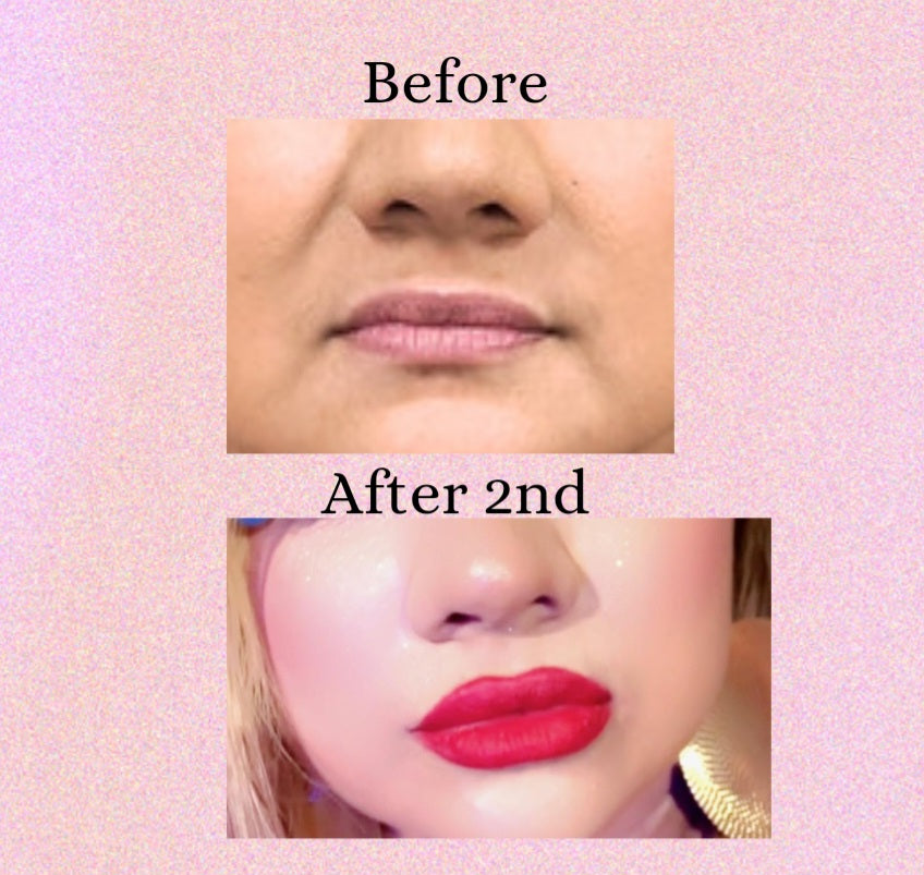 Lip Filler Hyaluronic Pen plump lips non-injection treatment