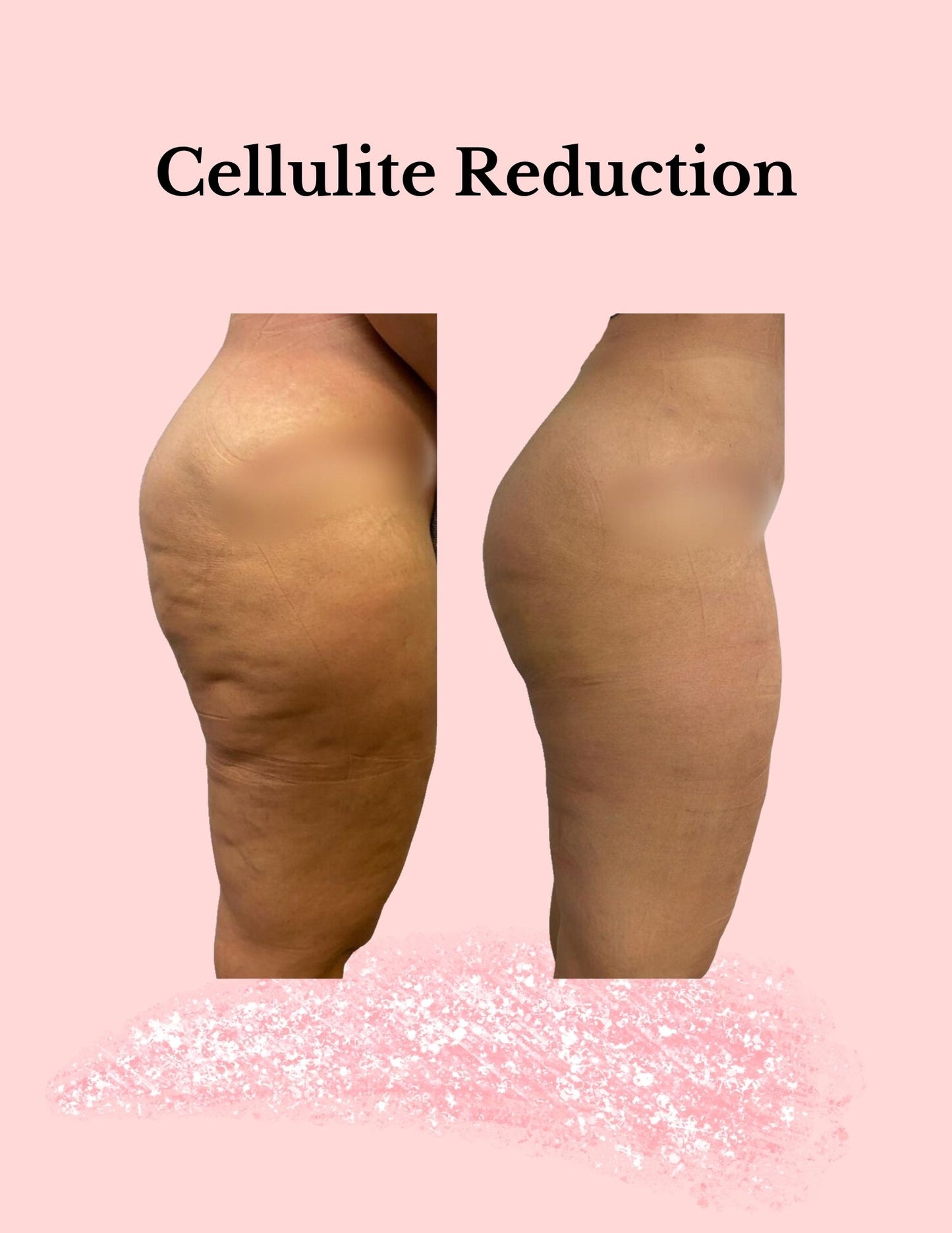 Cellulite & Fat Reducing Oil