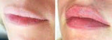 Lip Fillers Non-injection (painless)
