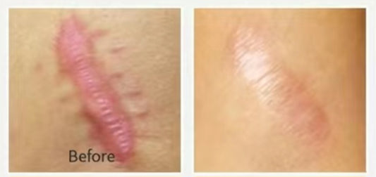 All Scar Treatments