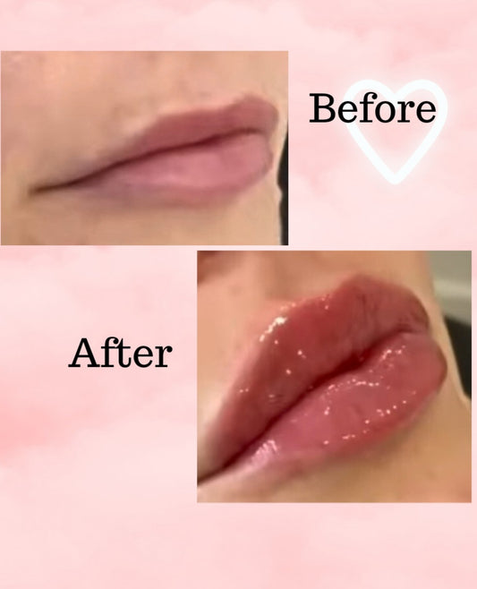 Lip Filler Hyaluronic Pen plump lips non-injection treatment