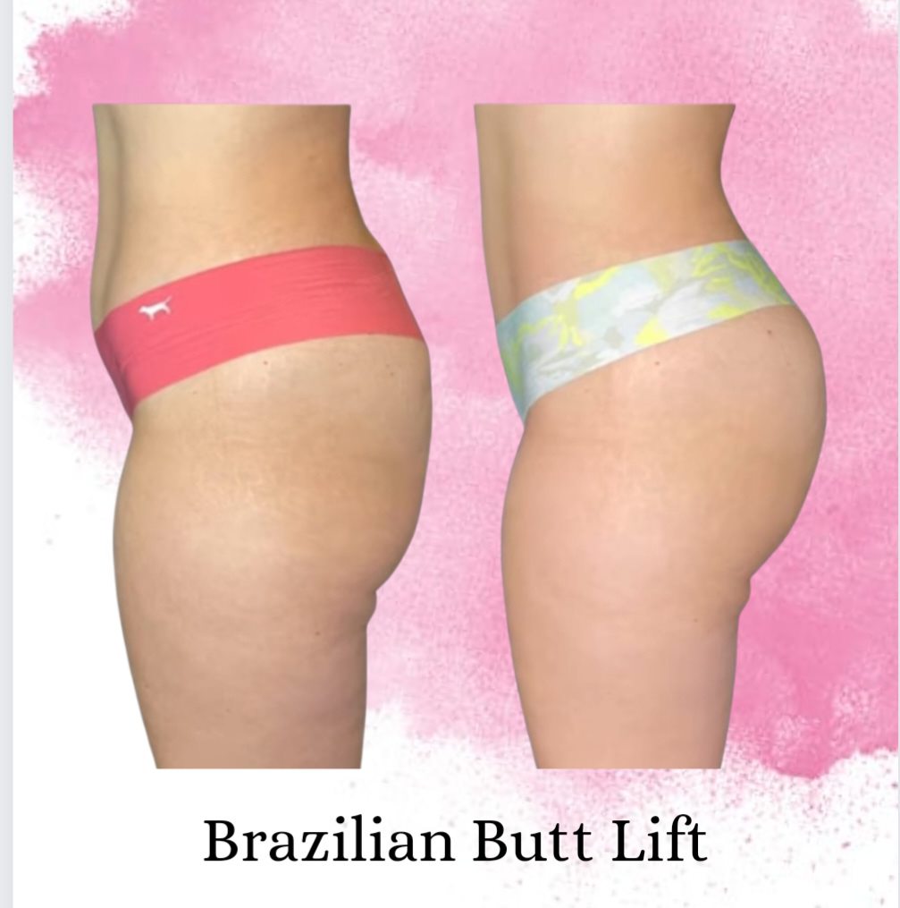 Buttocks Enhancement Pills