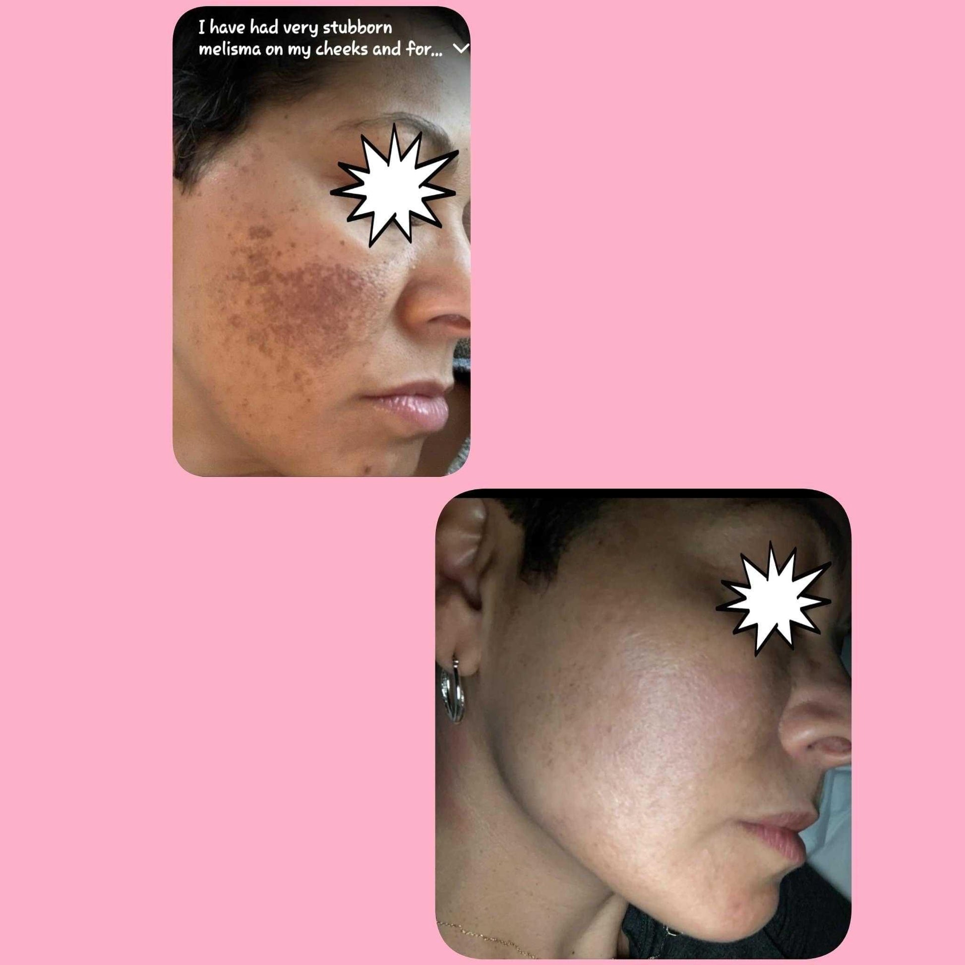 Hyperpigmentation -Brown Away/ Kojic Acid Spot Remover Moisturizer Hyperpigmentation -Brown Away/ Kojic Acid Spot Remover Moisturizer 20 Acne Treatments