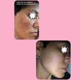 Hyperpigmentation -Brown Away/ Kojic Acid Spot Remover Moisturizer Hyperpigmentation -Brown Away/ Kojic Acid Spot Remover Moisturizer 20 Acne Treatments