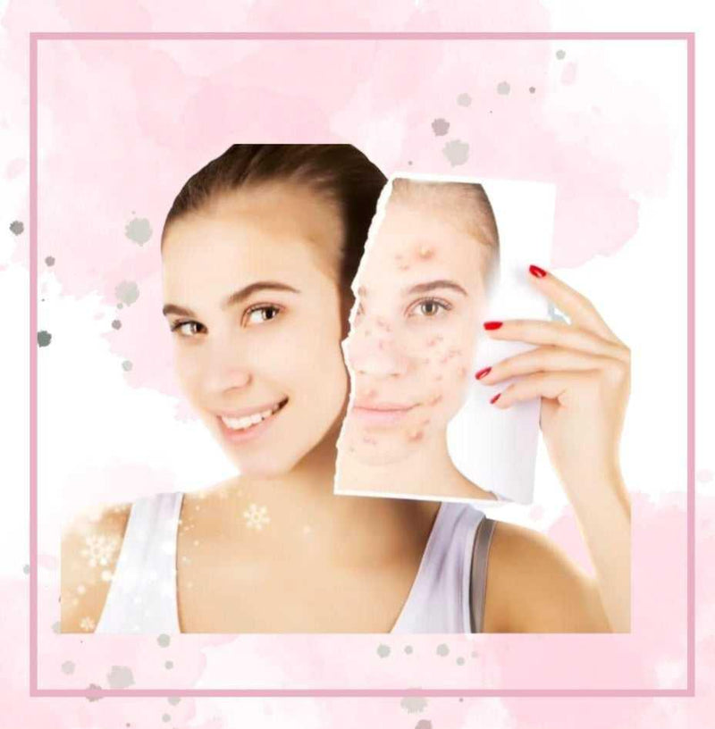 Natural Acne Products Natural Acne Products 17 Acne Treatments
