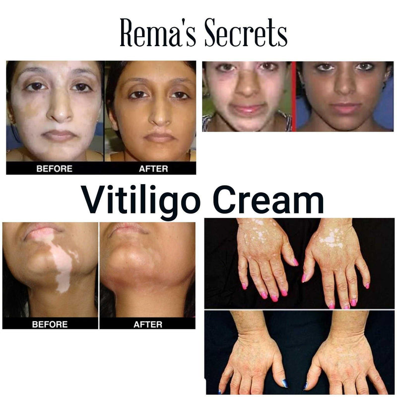 Vitiligo Repigmentation Cream Vitiligo Repigmentation Cream 25 Creams/Serums