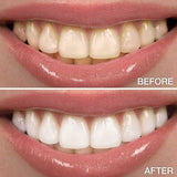 Whitening OR/ Cavity Repair Treatment Whitening OR/ Cavity Repair Treatment charcoal bleach 7 Enhancements