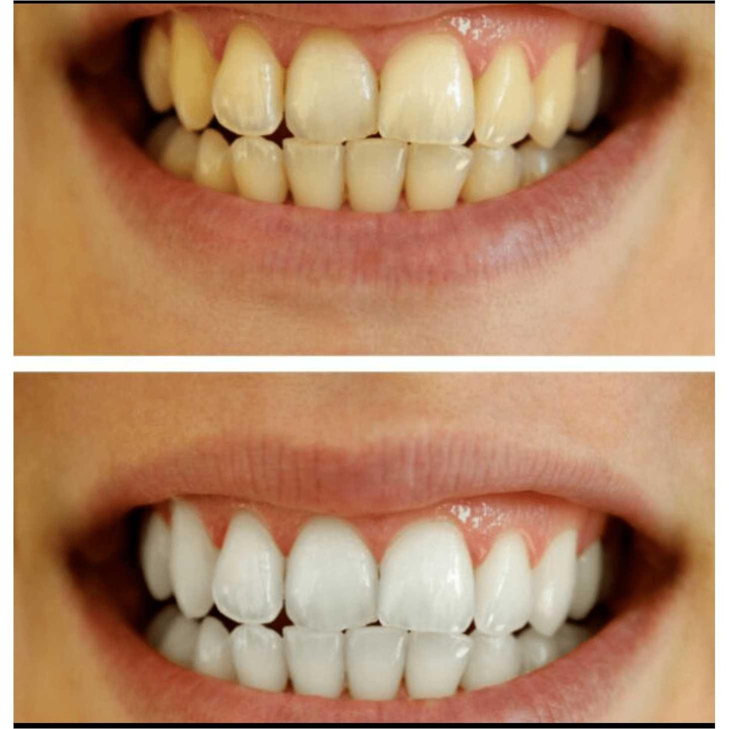 Whitening OR/ Cavity Repair Treatment Whitening OR/ Cavity Repair Treatment charcoal bleach 7 Enhancements