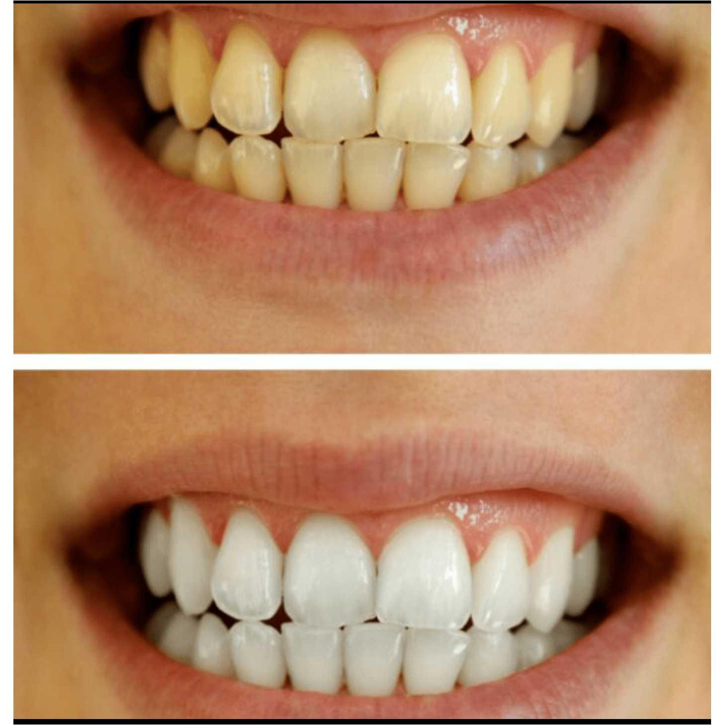 Whitening OR/ Cavity Repair Treatment Whitening OR/ Cavity Repair Treatment charcoal bleach 7 Enhancements