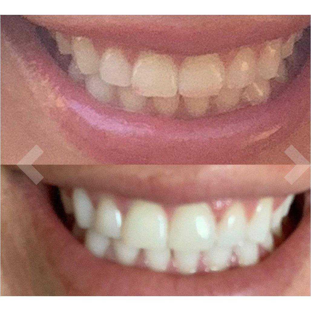 Whitening OR/ Cavity Repair Treatment Whitening OR/ Cavity Repair Treatment charcoal bleach 7 Enhancements